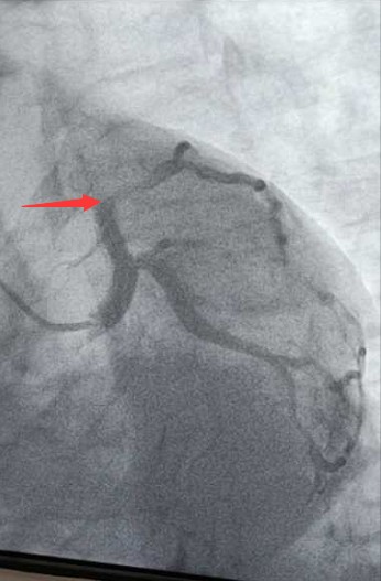 介入手术前的冠脉造影，冠状动脉左前降支已完全堵塞 (2).png