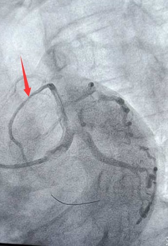介入手术后的冠脉造影，血管已经疏通 (2).png