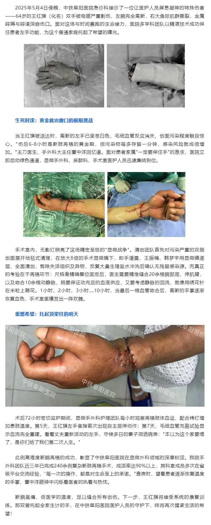 断腕八小时的生命奇迹：中铁阜阳医院显微手外科团队成功再植复杂离断伤.jpg
