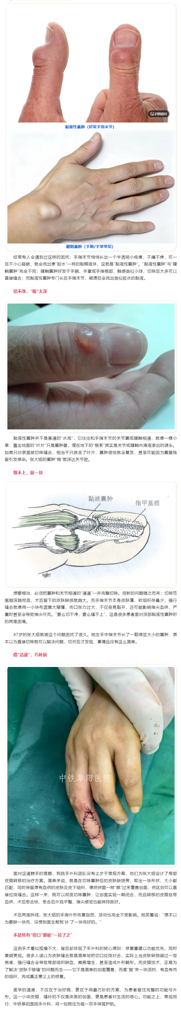 手指上长了&ldquo;胶水&rdquo;小疙瘩？看手外科医生巧打&ldquo;活&rdquo;补丁.jpg