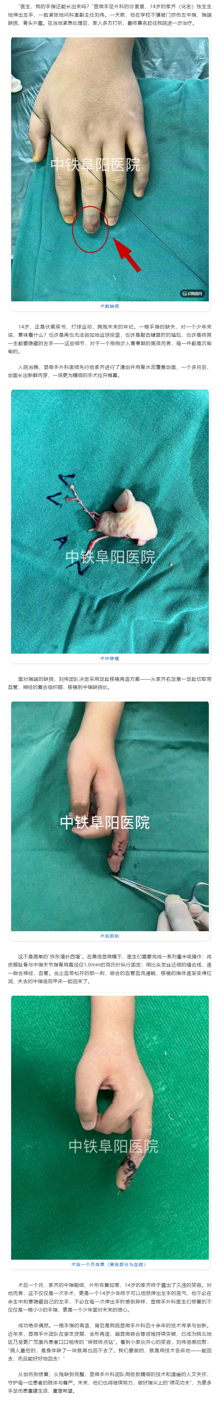 &ldquo;医生，我的手指还能长出来吗？&rdquo;&mdash;&mdash;14岁少年中指重生记.jpg